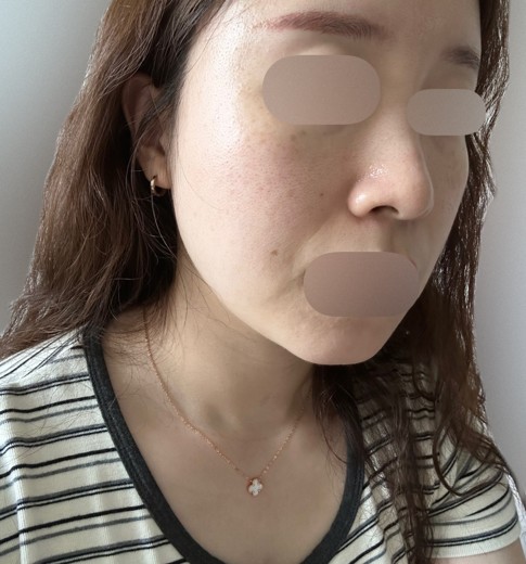 before photo: 점제거시술