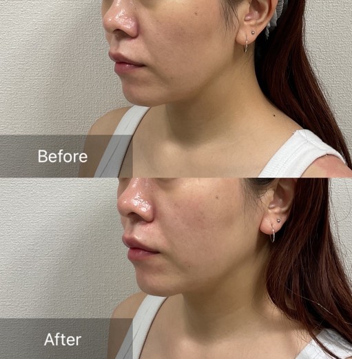 before photo: ピーリング, チタニウムリフト