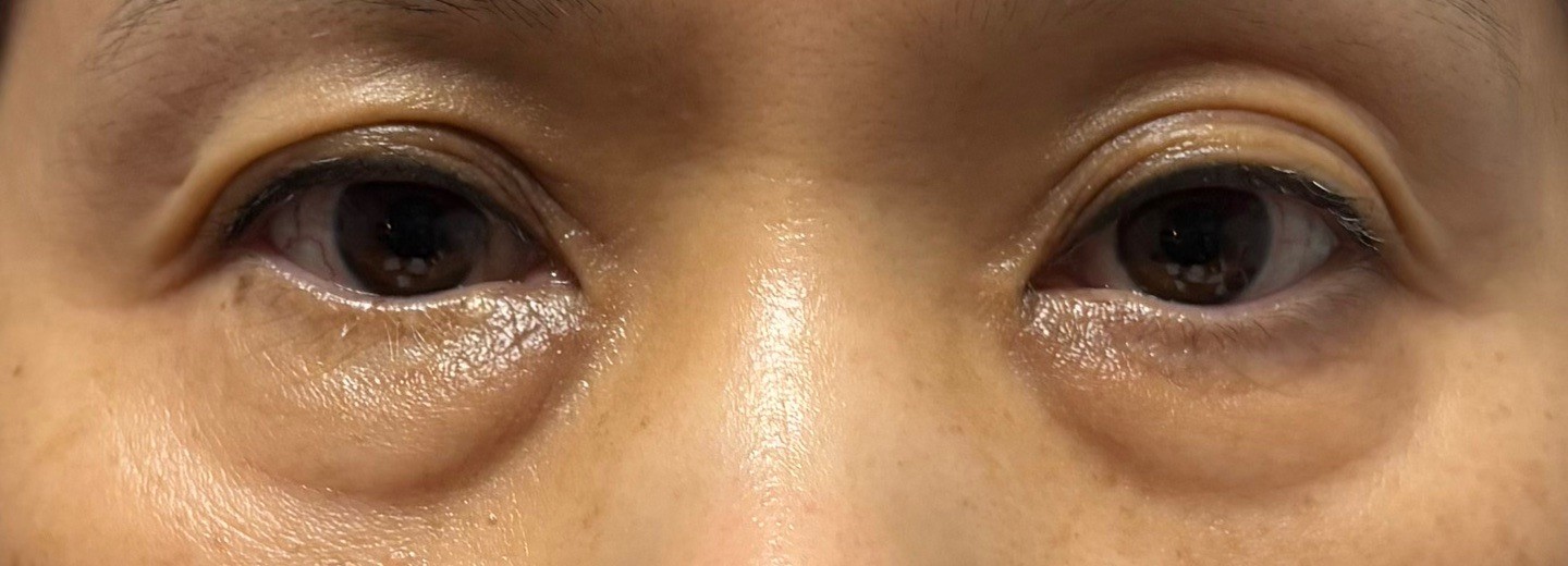 before photo: 눈밑지방재배치