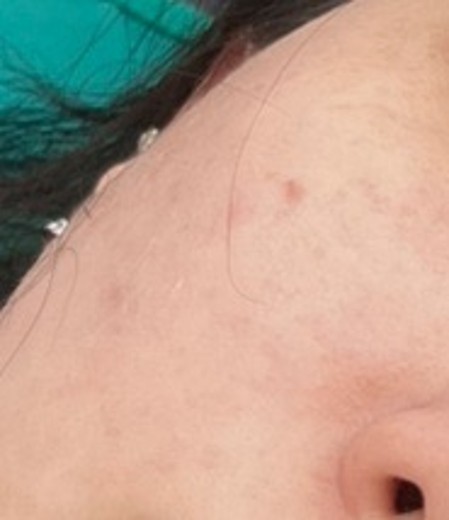 before photo: CO2레이저, 비립종제거, 사마귀제거