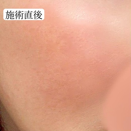 after photo: ルメッカ