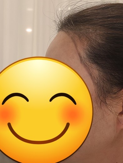 before photo: 머리모발이식