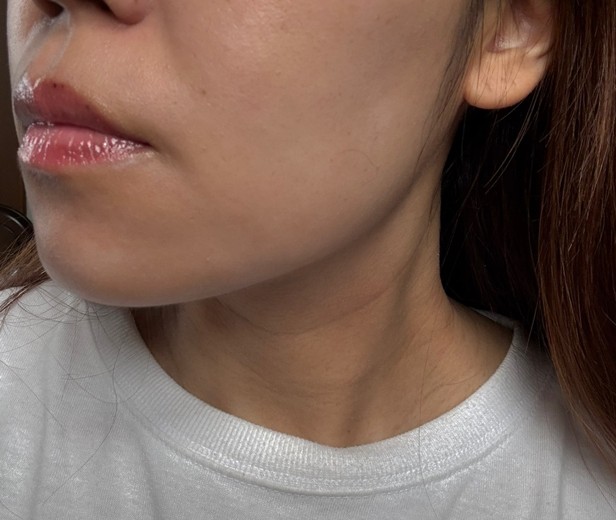 after photo: 脂肪溶解注射(顔)