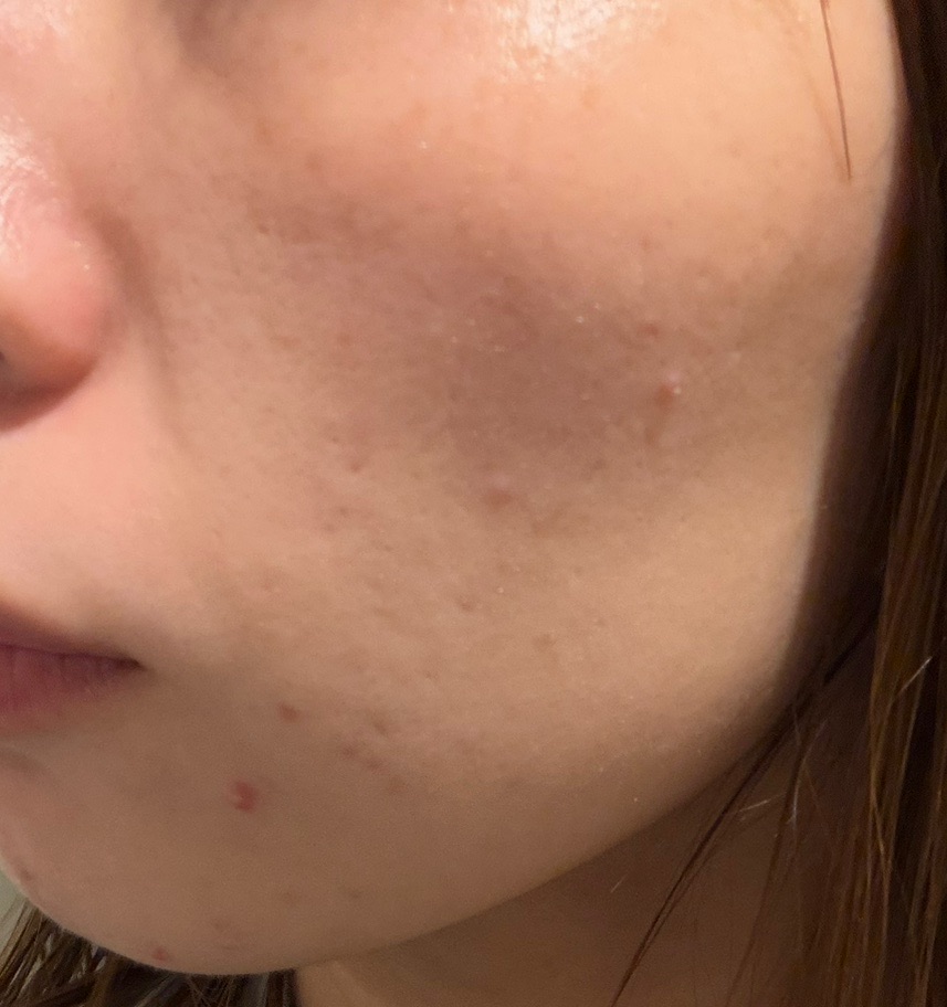 ケミカルピーリング｜全顔｜サリチル酸マクロゴール使用｜肌質改善基礎