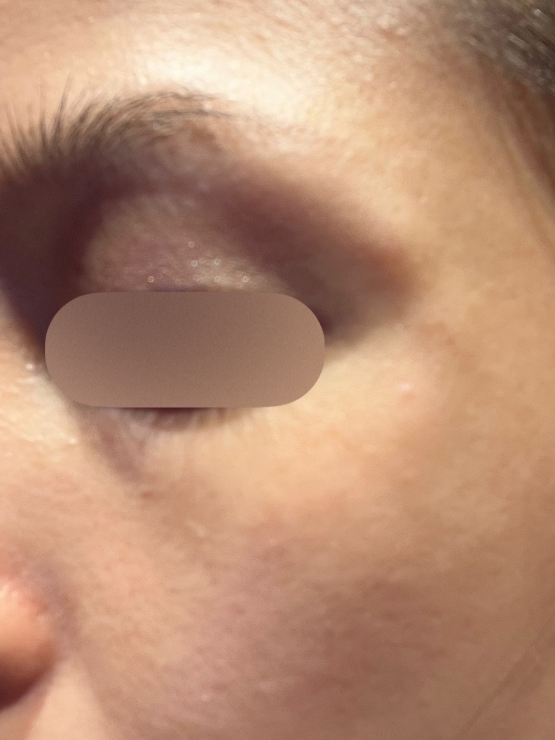 ボトックスによるシワ取り施術の詳細, image size:792x1056