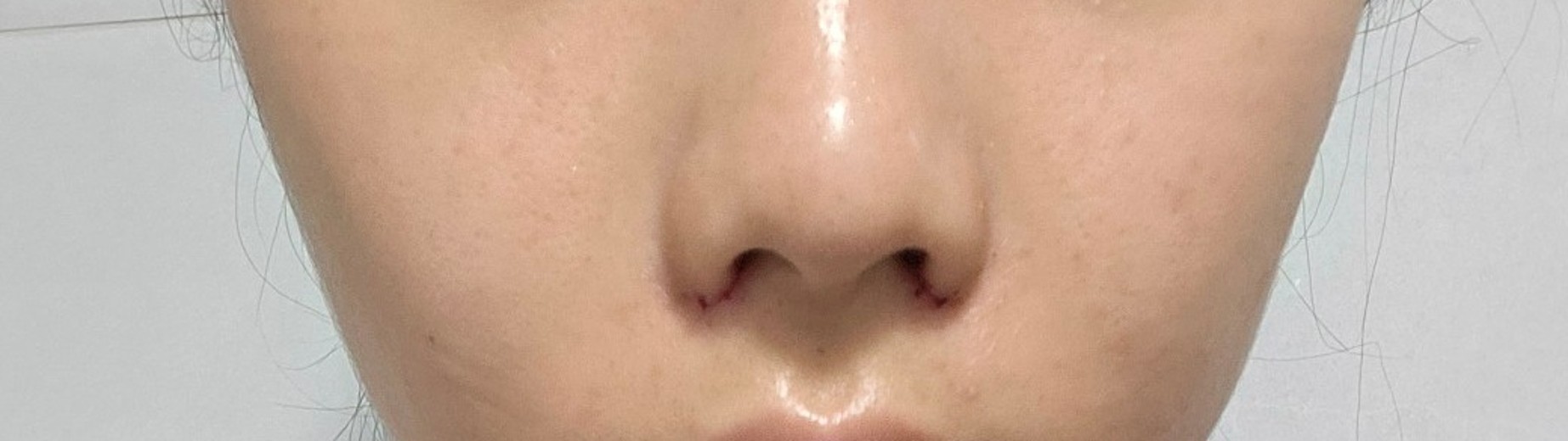 after photo: 콧볼축소