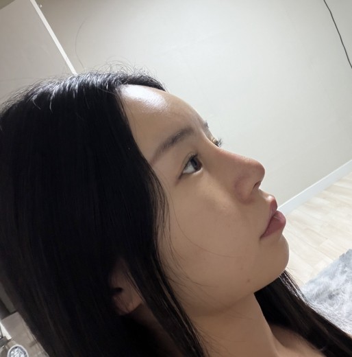 after photo: 콧대(보형물), 코끝(자가연골), 복코교정(수술)