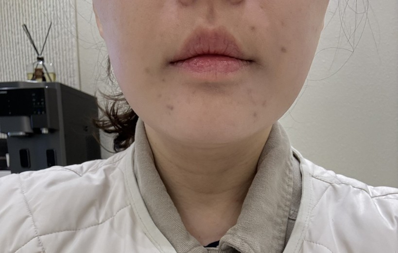 after photo: 티타늄리프팅