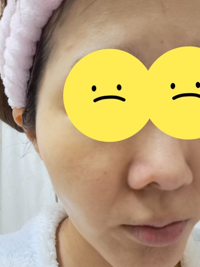 before photo: ピーリング, エレクトロポレーション, ルメッカ