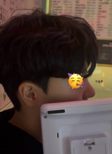 after photo: 비중격만곡증수술, 콧대(보형물), 코끝(자가연골)