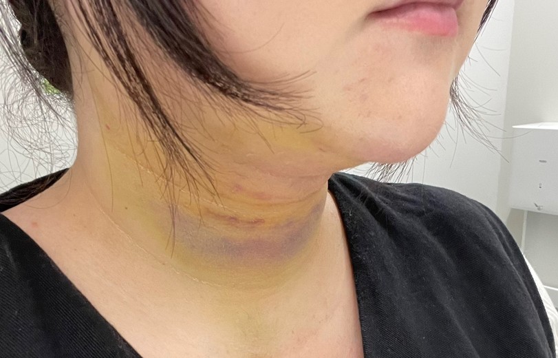 after photo: 脂肪吸引(顎下)