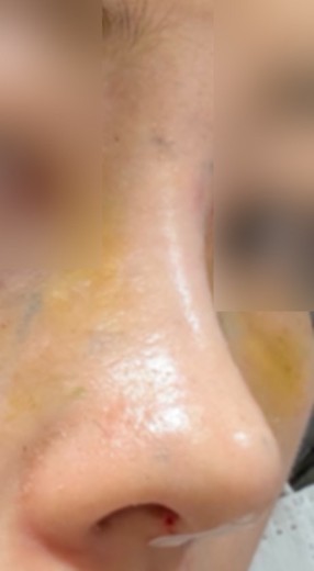after photo: 콧대(보형물), 코끝(자가연골)