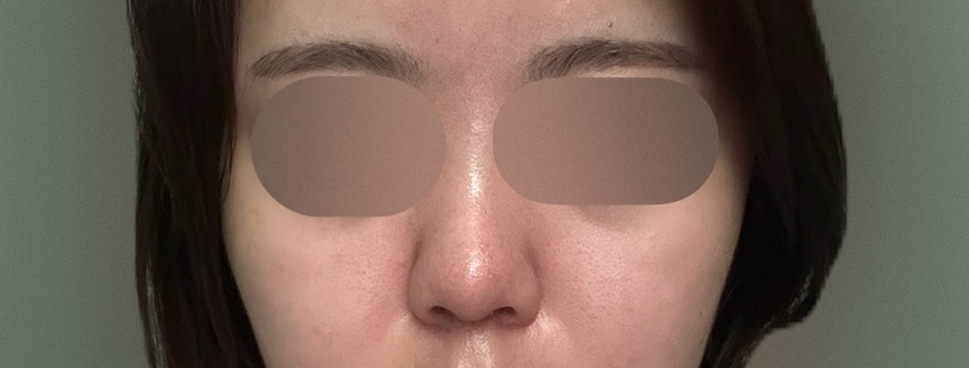 after photo: 콧대(보형물), 코끝(자가연골), 복코교정(수술)