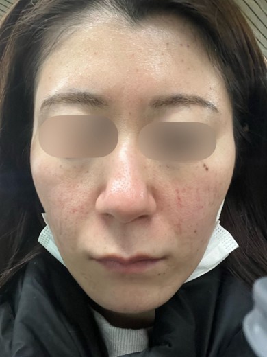 after photo: 水光注射, ジュベルック(Juvelook)