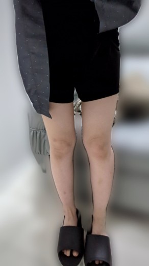 before photo: 脂肪溶解注射(腕), 脂肪溶解注射(太もも)