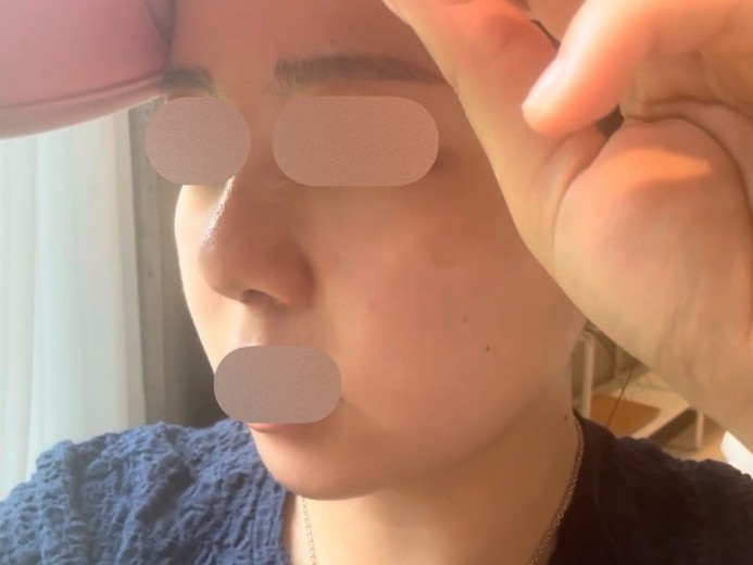 after photo: 콧대(보형물), 코끝(자가연골), 복코교정(수술)