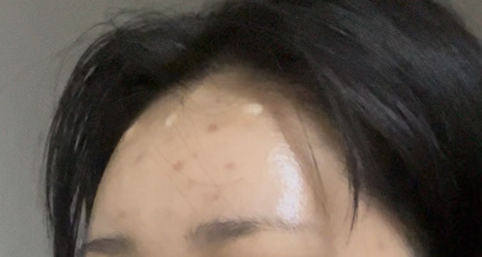 after photo: 이마필러