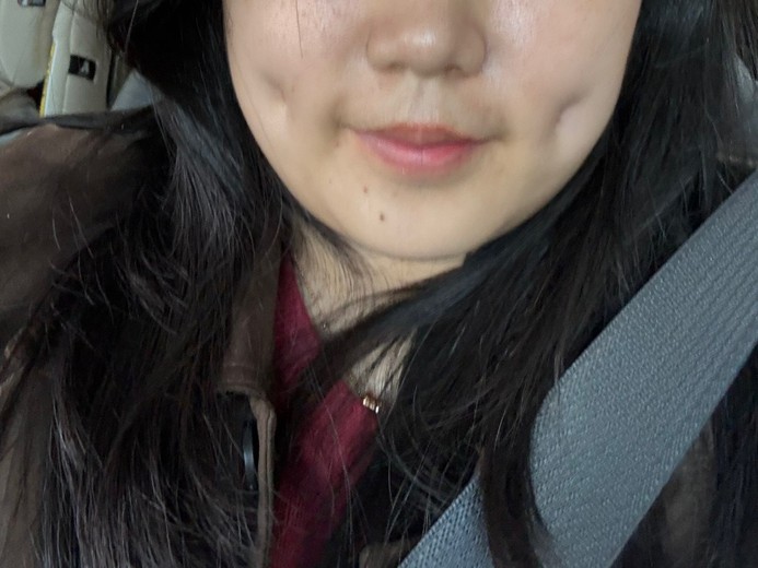 after photo: 보조개성형