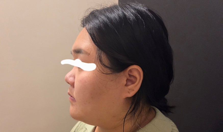 before photo: 비중격만곡증수술, 코끝(보형물)