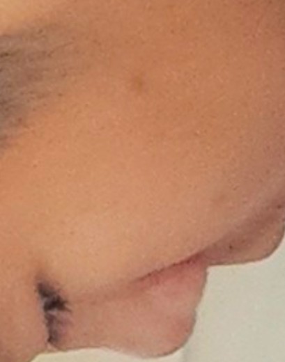 after photo: PDT레이저, 여드름압출