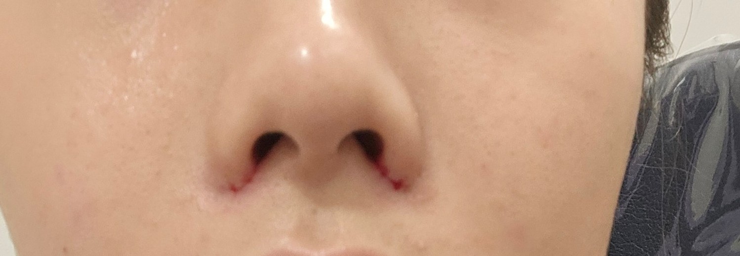 after photo: 콧볼축소