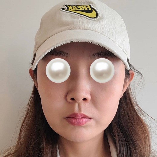 before photo: 울쎄라피프라임