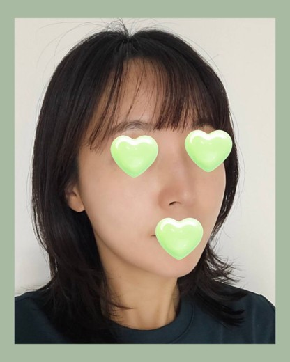 after photo: 티타늄리프팅