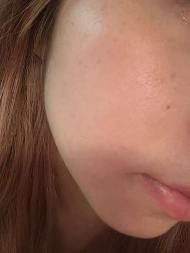 after photo: IPL(光/フォト治療)