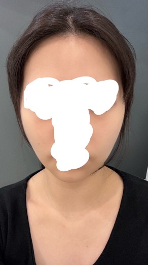 after photo: 실리프팅