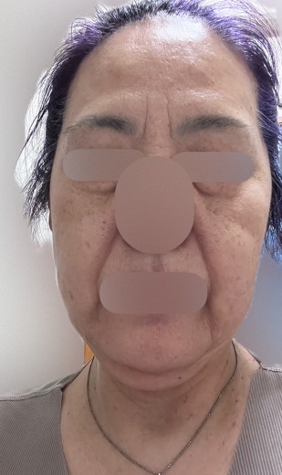 after photo: 脂肪溶解注射(顔)