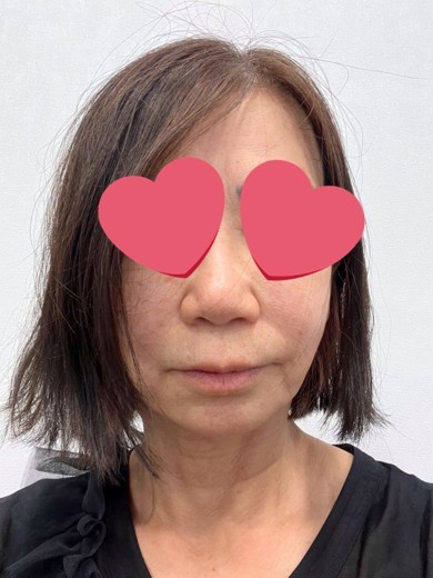 before photo: 水光注射, リジュランヒーラー