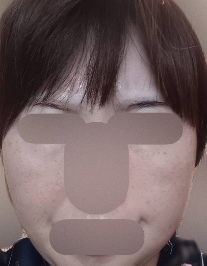 after photo: ミラノリピール