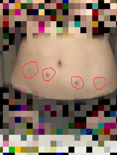 after photo: 脂肪溶解注射(腹部)