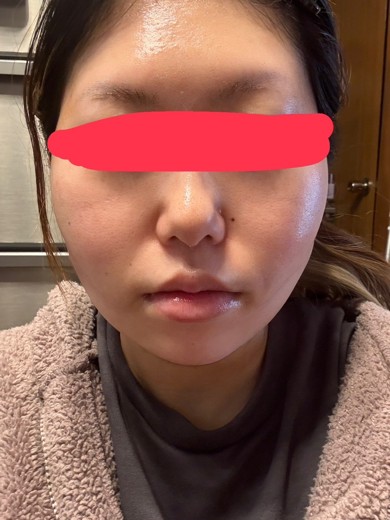 after photo: 糸リフト, 脂肪吸引(顎下), 脂肪吸引(顔), 脂肪吸引(頬)