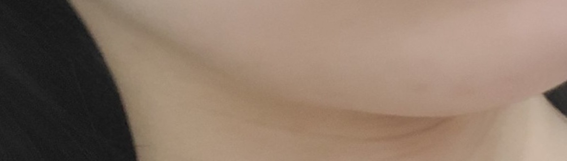 after photo: 윤곽주사