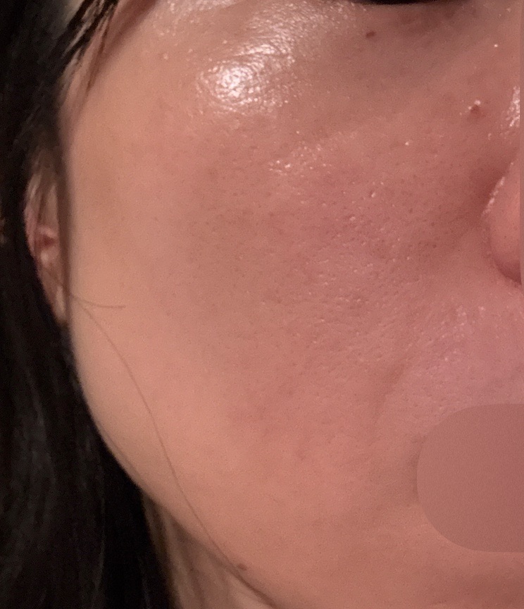 ピーリング　エレクトロポレーション 初診限定】ララピール（全顔）＋エレクトロポレーション