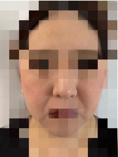 before photo: ピコスポット