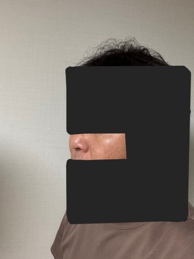 after photo: 눈밑지방재배치