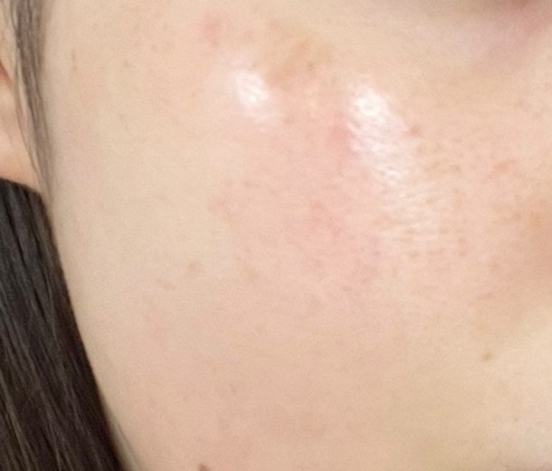 after photo: IPL(光/フォト治療), ピーリング, ルメッカ