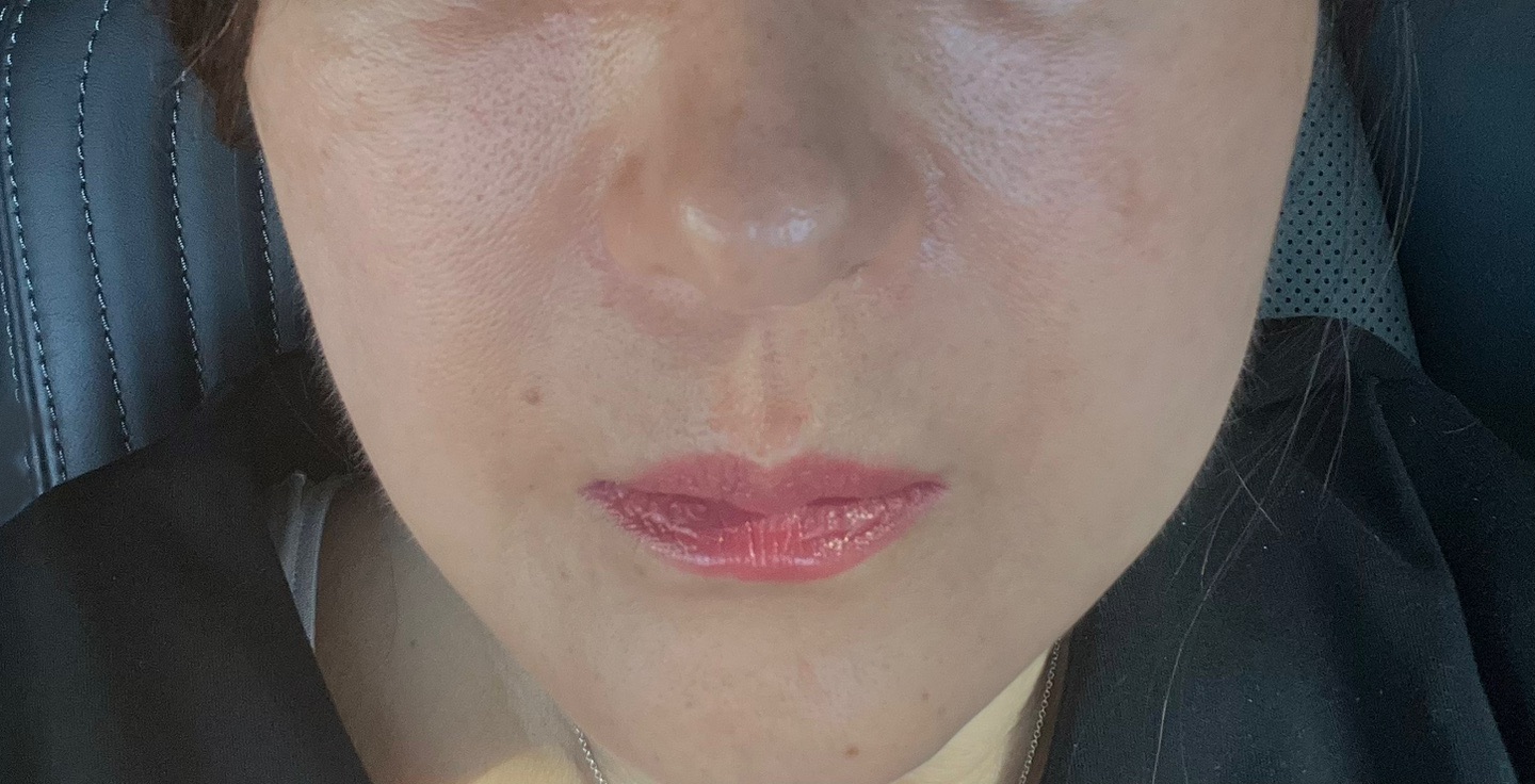 ポテンツァ ダイヤモンドチップ（全顔300ショット）たるみ・引き締めに