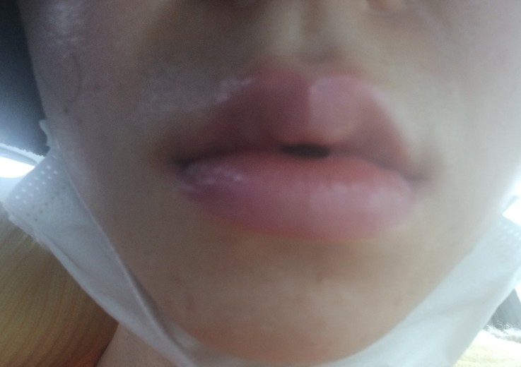 after photo: 입술필러