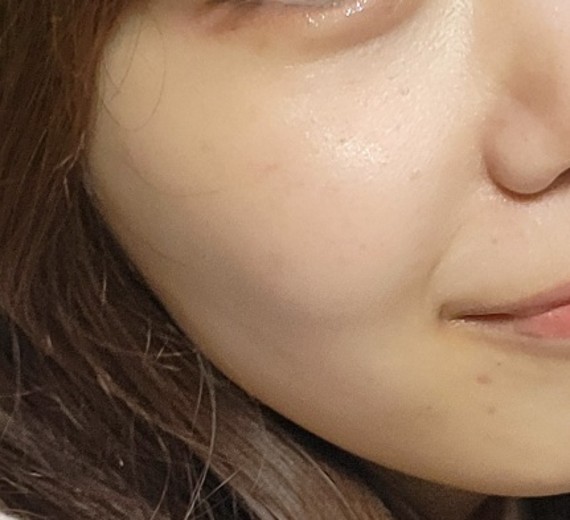 before photo: IPL(光/フォト治療), 診断・検査