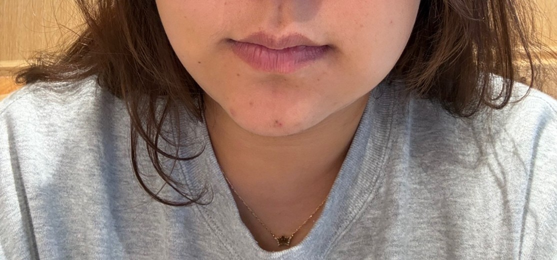 after photo: 이중턱지방흡입, 얼굴지방흡입, 이중턱근육묶기