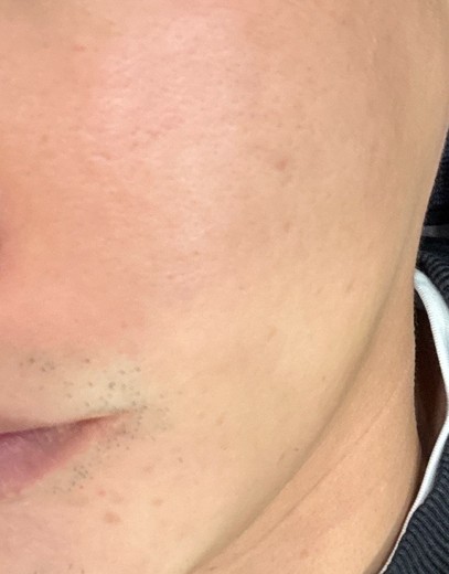 before photo: 인중제모