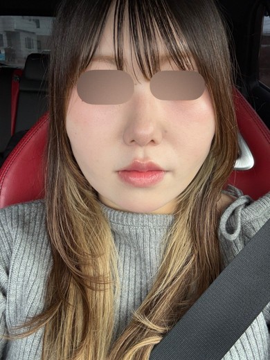 after photo: 糸リフト, 脂肪吸引(顎下), 脂肪吸引(顔), 脂肪吸引(頬)