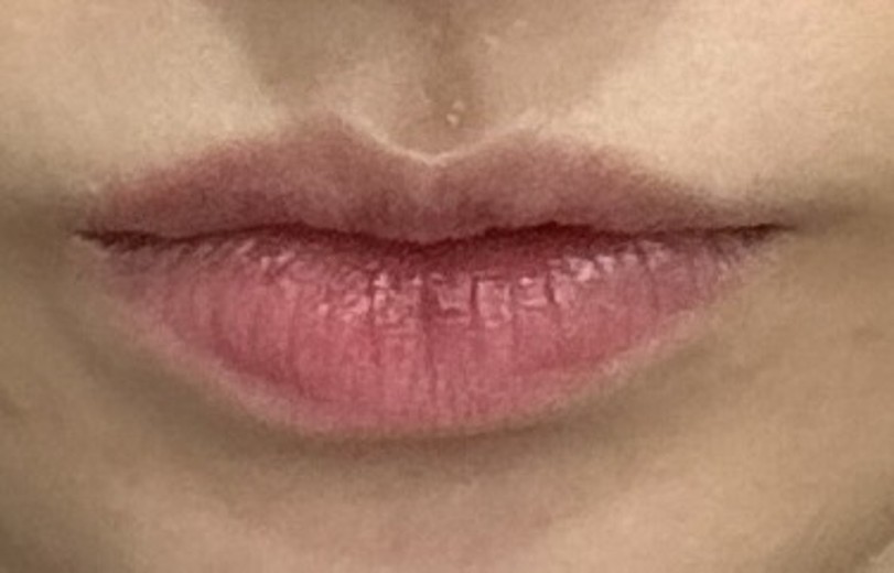 before photo: 입술필러