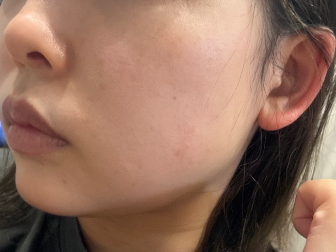 after photo: あごヒアルロン酸, 頬ヒアルロン酸