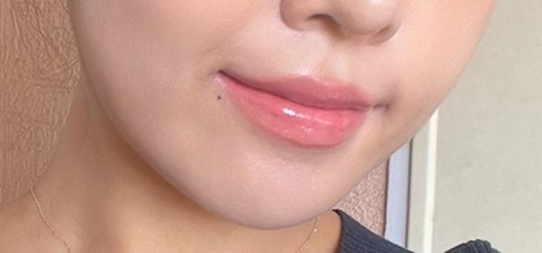 after photo: 윤곽주사