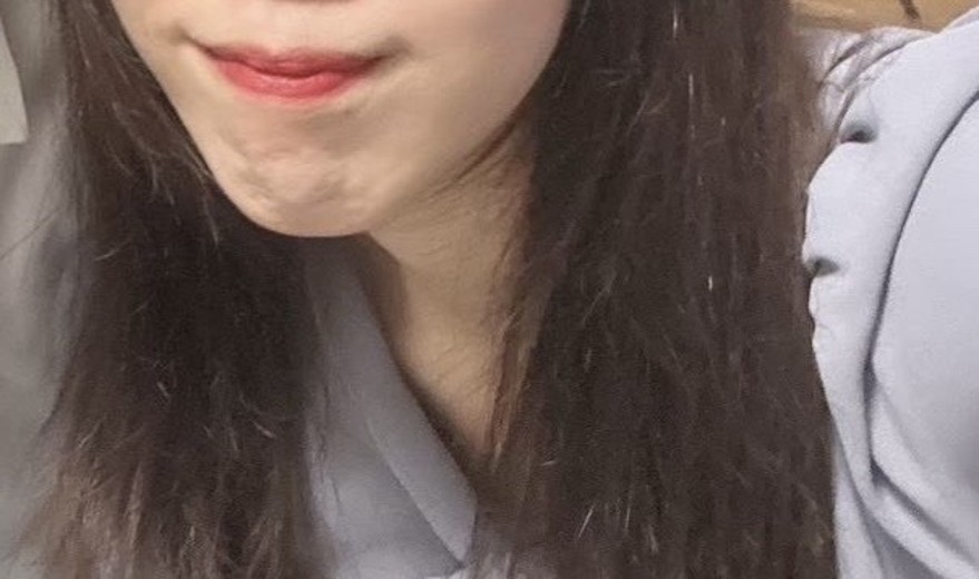 before photo: 小じわボトックス