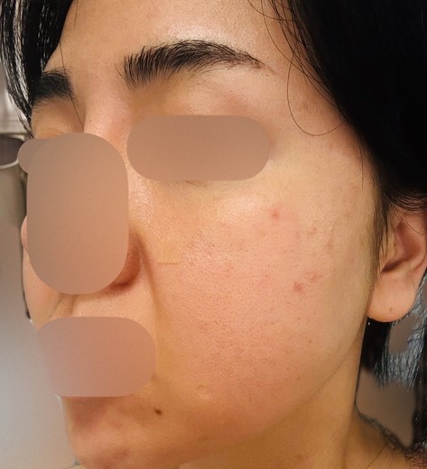 before photo: PRP피부재생술